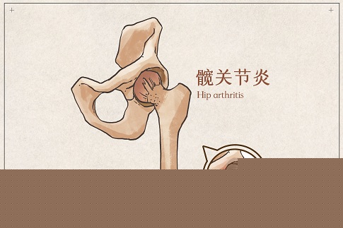 1655656942198987.jpg 攝圖網(wǎng)_401789354_髖關(guān)節(jié)炎示意圖(企業(yè)商用).jpg