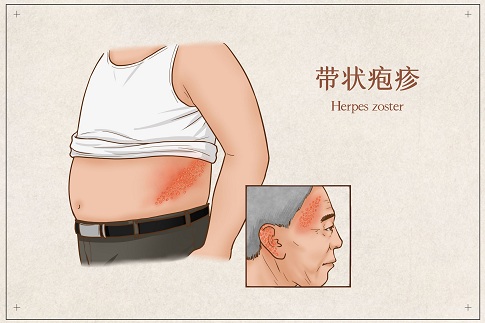 1655737958179292.jpg 攝圖網(wǎng)_401800774_banner_帶狀皰疹醫(yī)療插畫(huà)(企業(yè)商用).jpg
