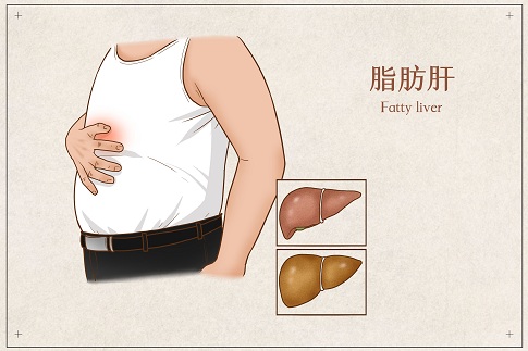 1660495638410305.jpg 攝圖網(wǎng)_401804062_脂肪肝醫(yī)療插畫(企業(yè)商用).jpg