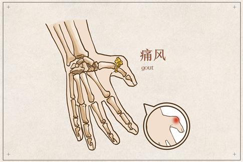 1662050688400722.jpg 攝圖網(wǎng)_401795635_banner_手部痛風(fēng)病例(非企業(yè)商用).jpg