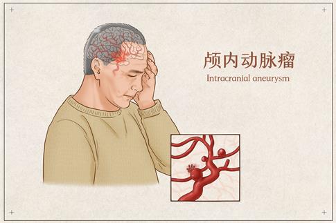 1701071482469643.jpg 攝圖網(wǎng)_401796266_顱內(nèi)動脈瘤醫(yī)療插畫(企業(yè)商用).jpg