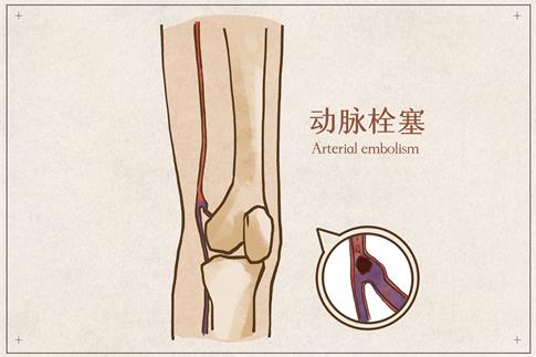 1708917056371122.jpg 攝圖網(wǎng)_401790480_動脈栓塞醫(yī)療插畫(企業(yè)商用).jpg