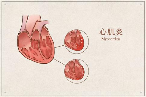 1716259127897064.jpg 攝圖網(wǎng)_401789429_心肌炎醫(yī)療插畫示意圖(企業(yè)商用).jpg