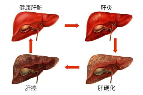 1718236176135802.jpg 攝圖網(wǎng)_401806707_banner_乙肝肝臟病變癥狀醫(yī)療插畫(企業(yè)商用).jpg