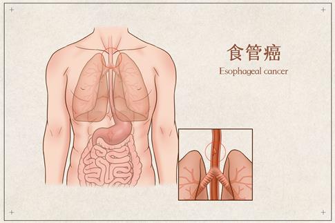1720050145790249.jpg 攝圖網(wǎng)_401863169_banner_食管癌醫(yī)療插畫(企業(yè)商用).jpg