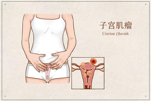 1720483433453109.jpg 攝圖網(wǎng)_401800161_子宮肌瘤醫(yī)療插畫(企業(yè)商用).jpg