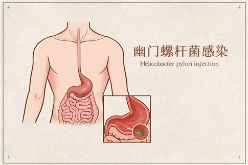 1750507413460226.jpg 攝圖網(wǎng)_401789751_banner_幽門螺桿菌感染醫(yī)療插畫(企業(yè)商用).jpg